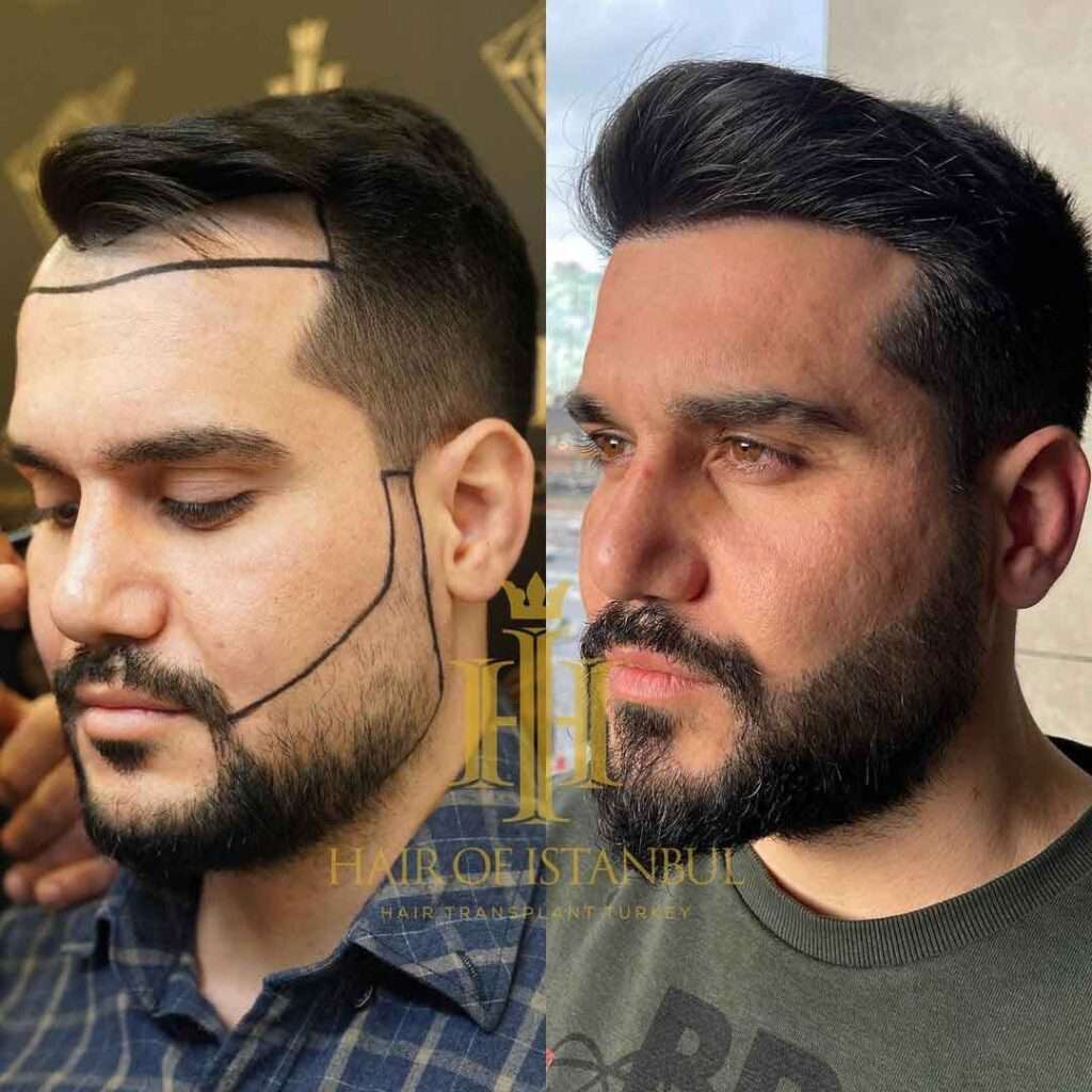 Hair of İstanbul Saç Ekimi Yorumları ve Fiyatları Saç Ekimi Forum