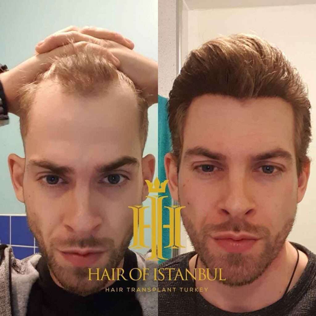 Hair of İstanbul Saç Ekimi Yorumları ve Fiyatları Saç Ekimi Forum