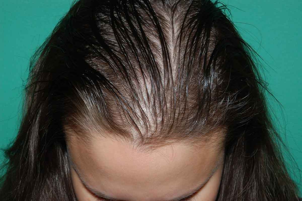 Kadınlarda Genetik Saç Dökülmesi