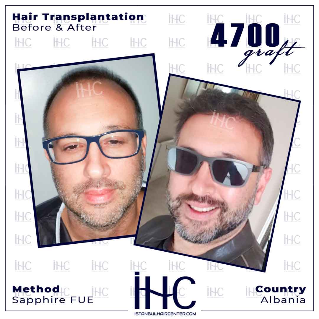 İstanbul Hair Center Saç Ekimi Sonuçları 1